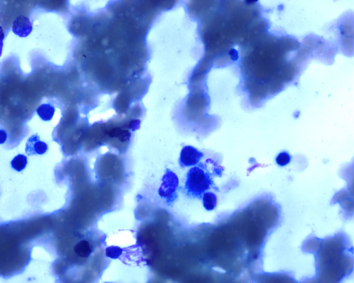 direct smear 60X micromegakaryocyte